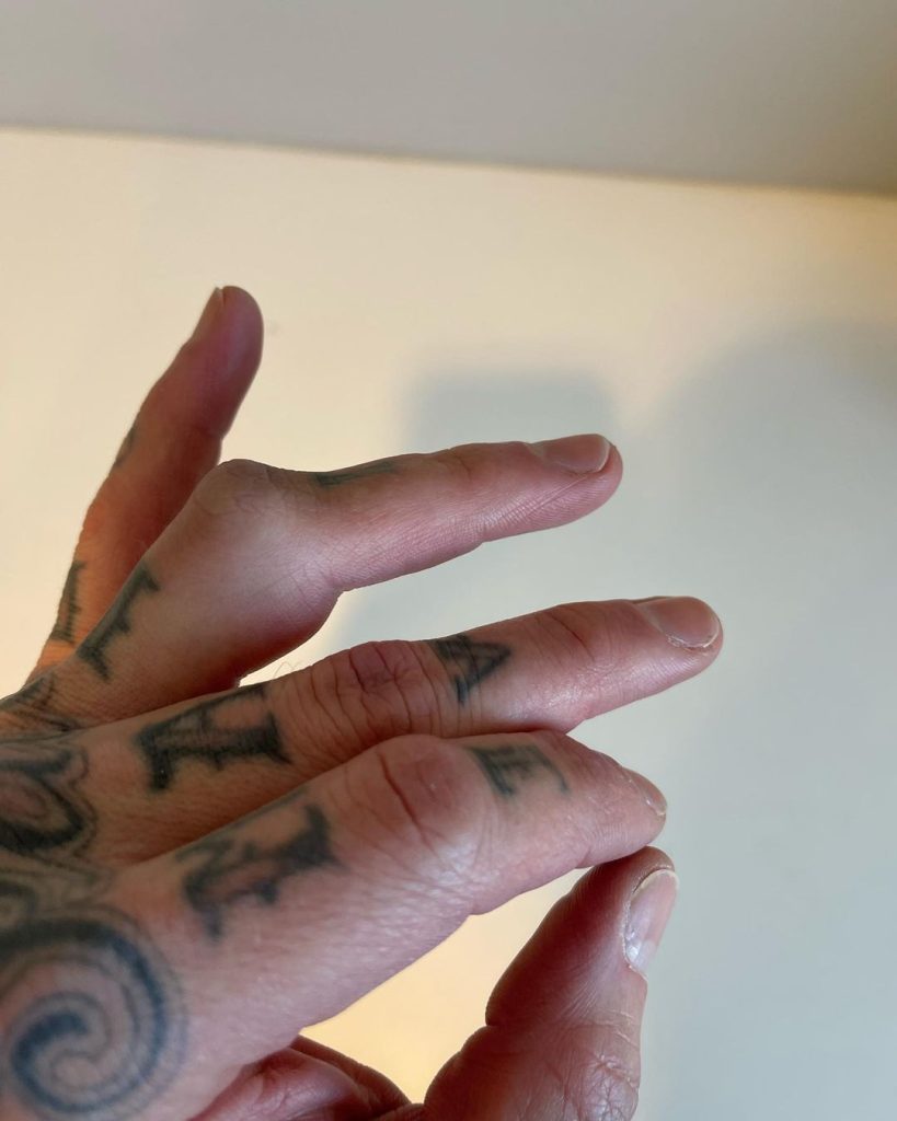 Travis Barker publica fotografía antes de su cirugía